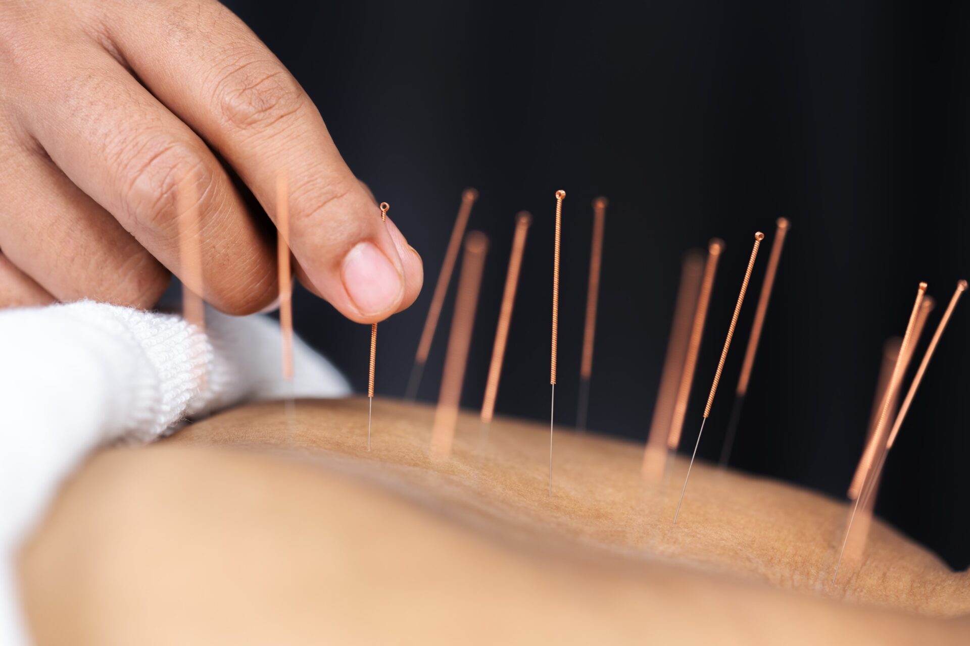 Is Acupuncture Safe for Car Accident Injury Recovery?