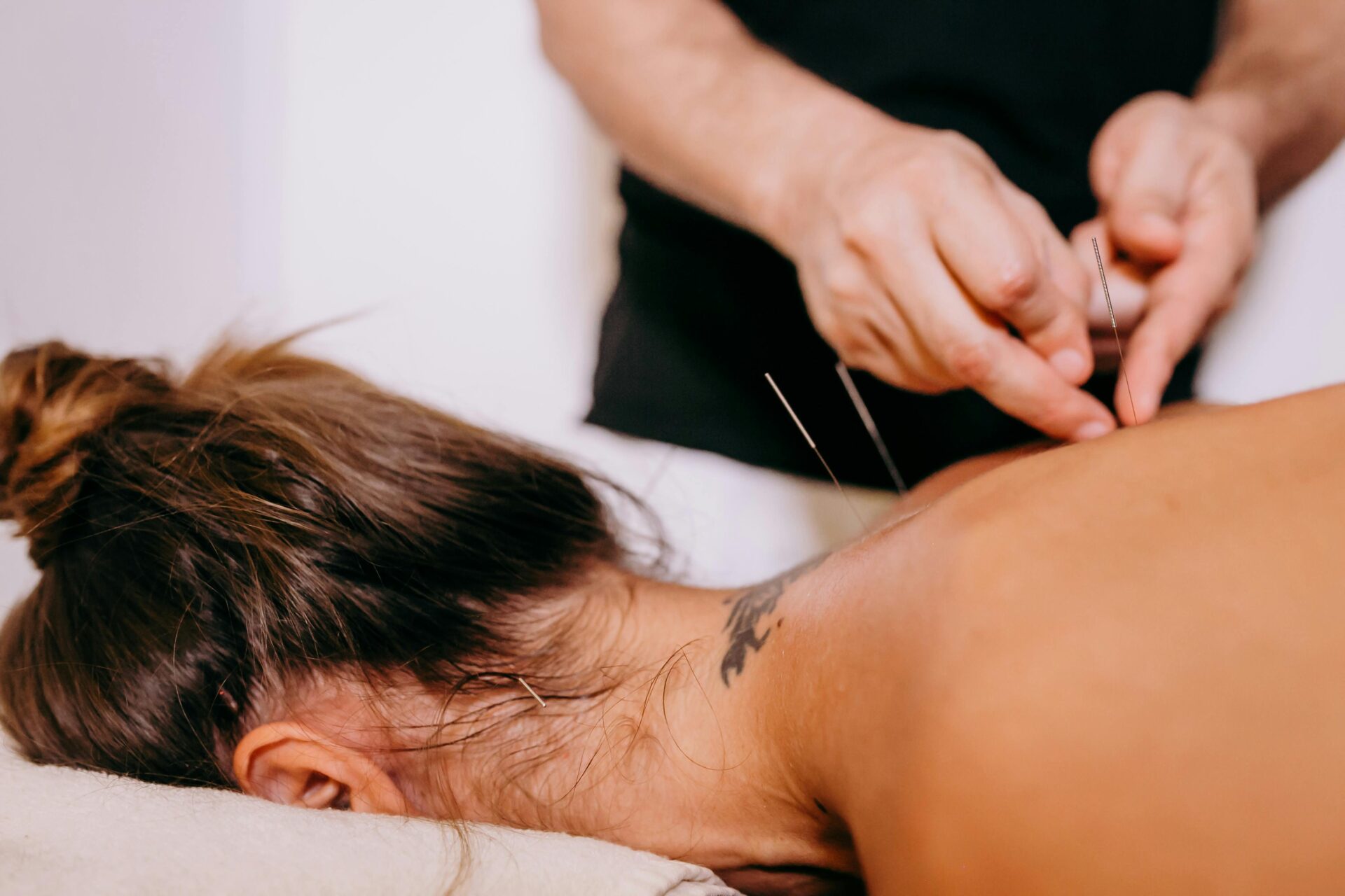 How Does Acupuncture Help Improve Athletic Performance?